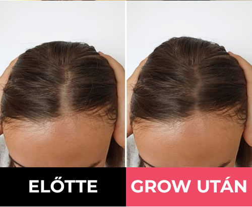 GROW Arany Mikrotűs Hajnövesztő Kezelés Nőknek