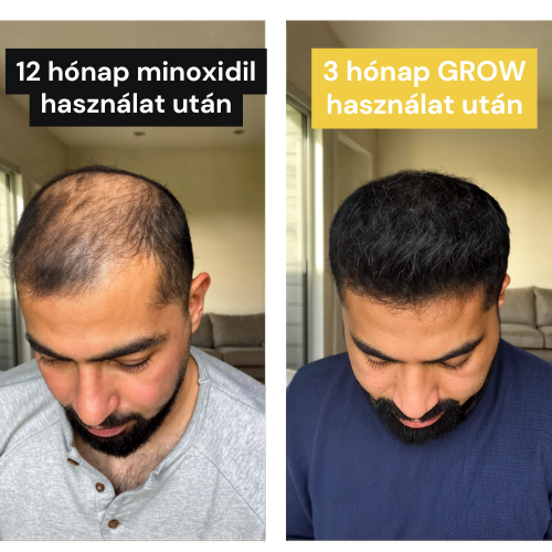 GROW Arany Mikrotűs Hajnövesztő Kezelés Férfiaknak