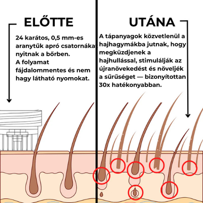 1 csomag GROW Arany Mikrotűs Hajnövesztő Kezelés Nőknek