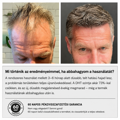 GROW Arany Mikrotűs Hajnövesztő Kezelés Férfiaknak