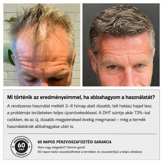 GROW Arany Mikrotűs Hajnövesztő Kezelés Férfiaknak
