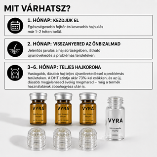 GROW Arany Mikrotűs Hajnövesztő Kezelés Férfiaknak
