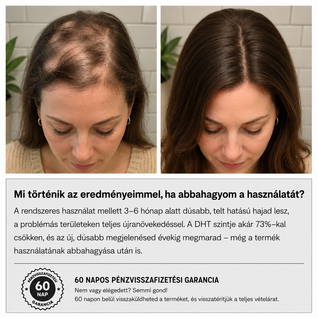 GROW Mikrotűs Hajnövesztő Rendszer Hajhullás Ellen Nőknek