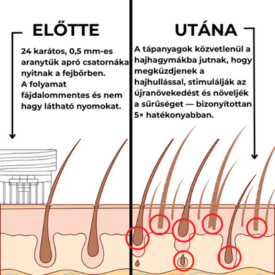 GROW Arany Mikrotűs Hajnövesztő Kezelés Férfiaknak
