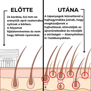 GROW Arany Mikrotűs Szakállnövesztő Kezelés Férfiaknak