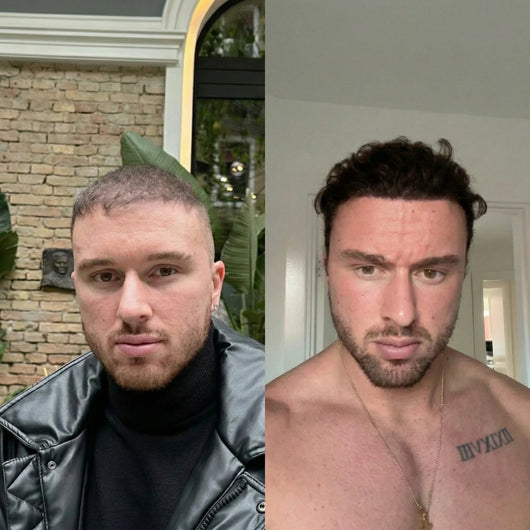 3 csomag GROW Arany Mikrotűs Hajnövesztő Kezelés Férfiaknak