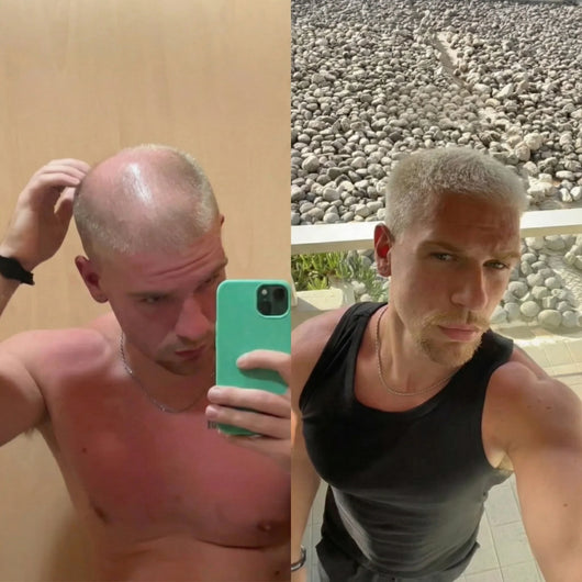 3 csomag GROW Arany Mikrotűs Hajnövesztő Kezelés Férfiaknak